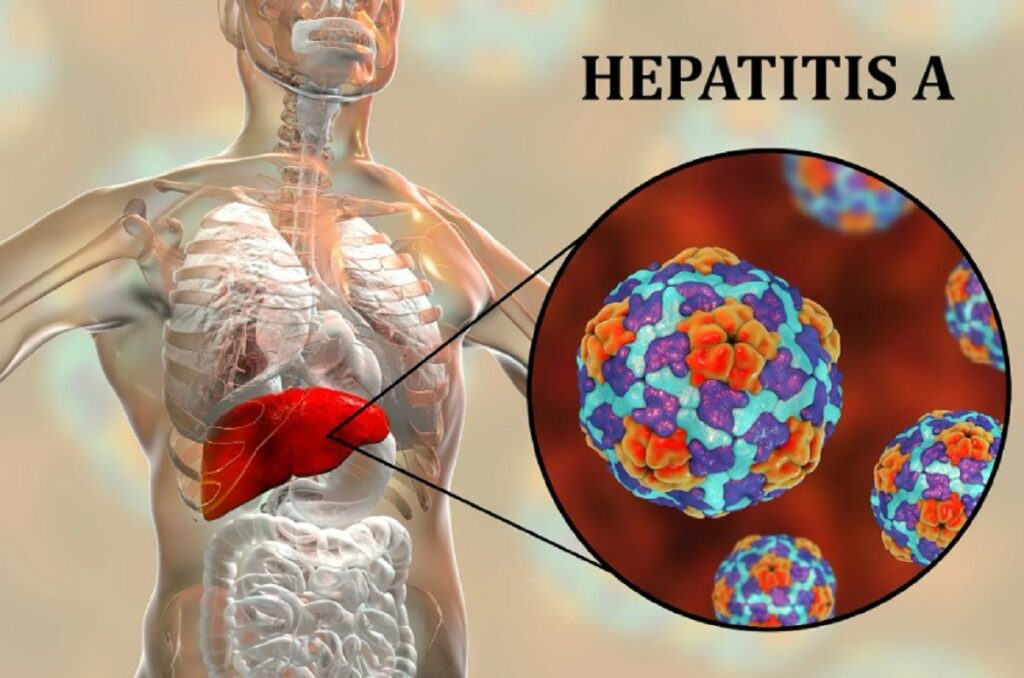 Sikkim Health Authorities respond to Hepatitis ‘A’ surge in Gangtok