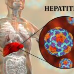 Sikkim Health Authorities respond to Hepatitis ‘A’ surge in Gangtok